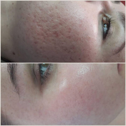 Jalevel - Hyaluronic Bio-Revitalizing Gel 2 ml - SKIN-BOOSTERS